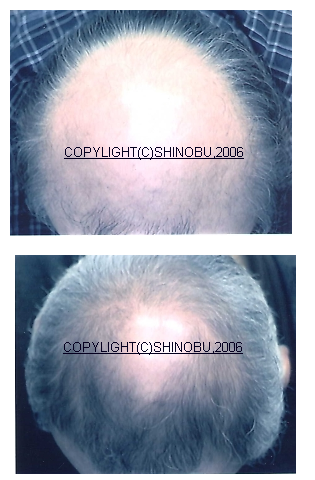 カツラ仕様変更と頭皮ケアで回復した頭皮状態