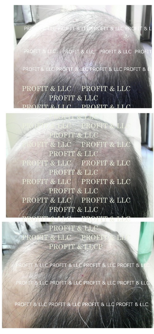 カツラ使用により悪化した頭皮炎症の状態