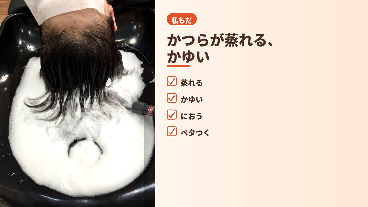かつら蒸れ、頭皮かゆみ。原因は装着方式かもしれません